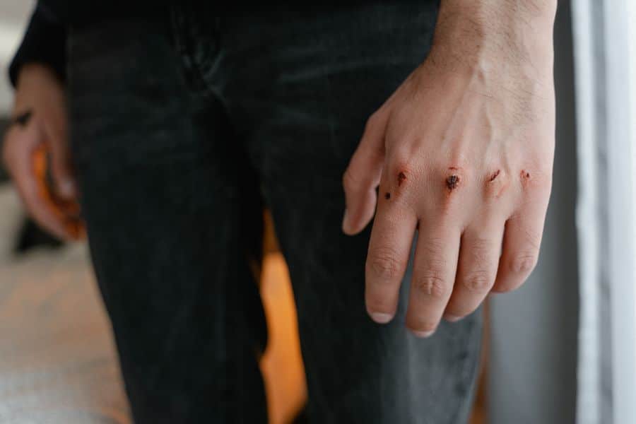 heridas lesiones mano 2 Heridas y lesiones en mano