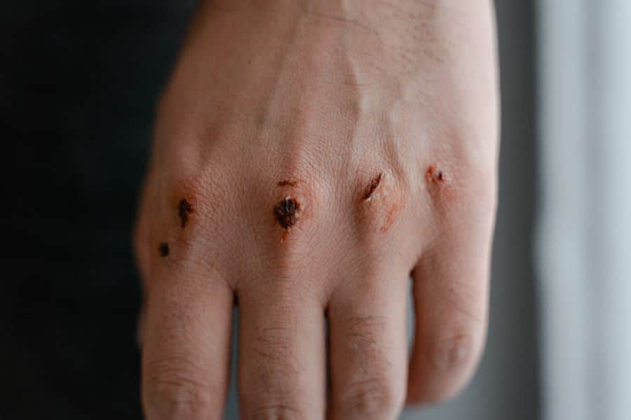 manos cicatrices deterioro cutaneo 1 Manos con cicatrices y deterioro cutáneo